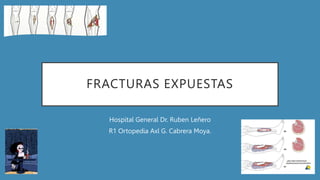 FRACTURAS EXPUESTAS
Hospital General Dr. Ruben Leñero
R1 Ortopedia Axl G. Cabrera Moya.
 
