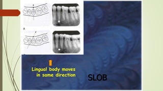 Using Slob Rule Radiograph Exraoral and intraoral radiography | PPTX