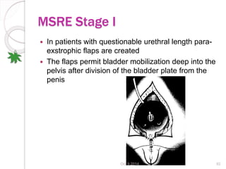 Bladder Exstophy and Epispadias | PPTX