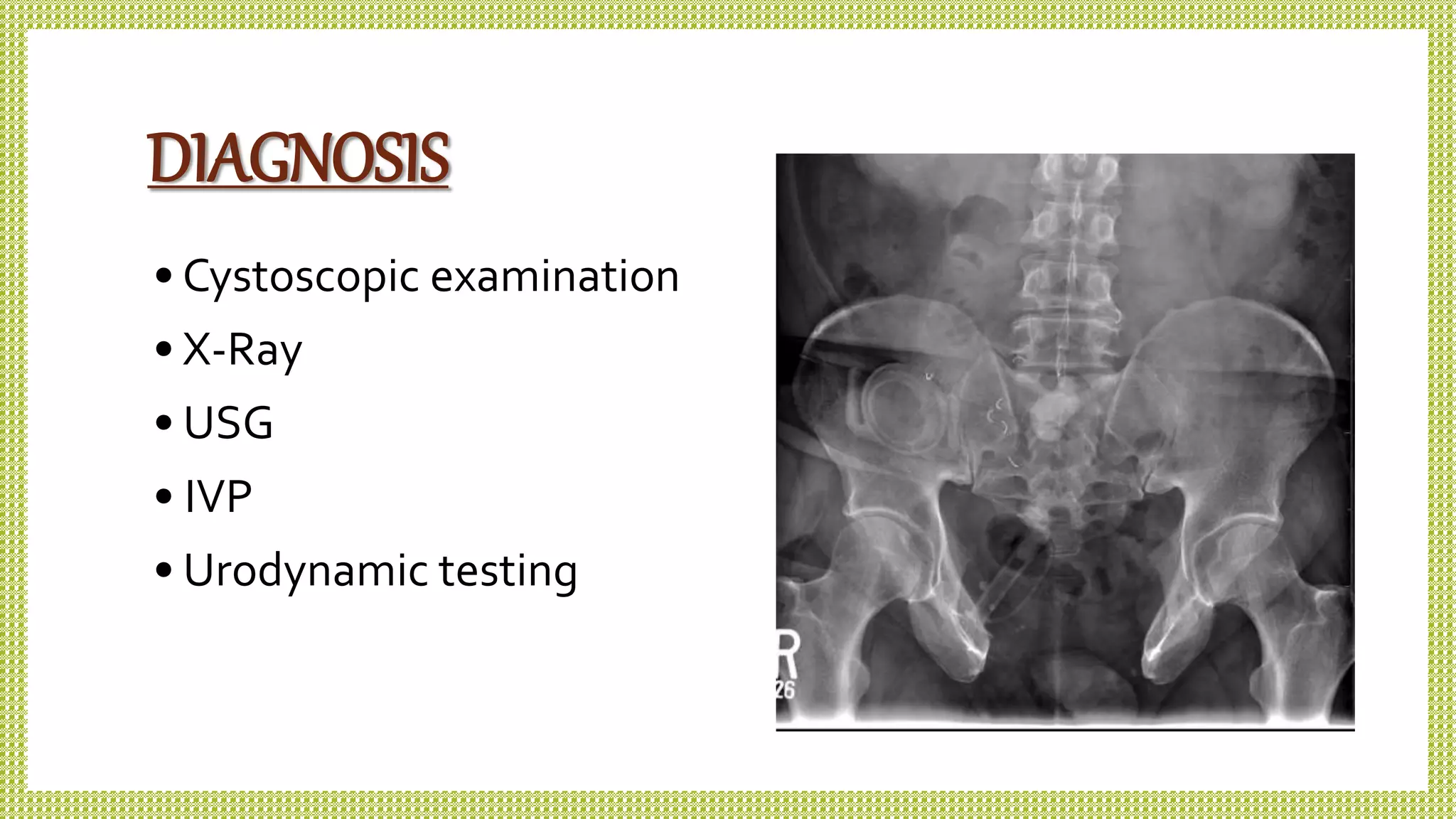 DIAGNOSIS
• Cystoscopic examination
• X-Ray
• USG
• IVP
• Urodynamic testing
 