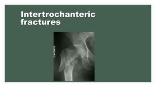 Intertrochanteric
fractures
 