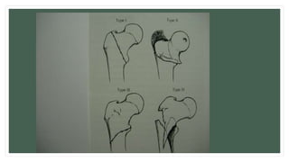 Intertrochanteric Fracture