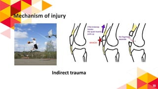 Mechanism of injury
15
Indirect trauma
 