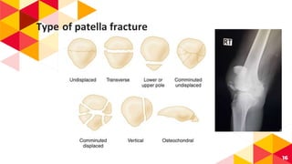 Type of patella fracture
16
 