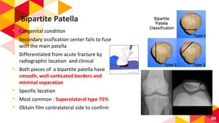 Bipartite Patella
◂ Congenital condition
◂ Secondary ossification center fails to fuse
with the main patella
◂ Differentiated from acute fracture by
radiographic location and clinical
◂ Both pieces of a bipartite patella have
smooth, well-corticated borders and
minimal separation
◂ Specific location
◂ Most common : Superolateral type 75%
◂ Obtain film contralateral side to confirm
20
 