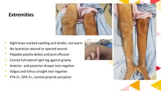 7
• Right knee marked swelling and tender, not warm
• No laceration wound or opened wound
• Palpable patella defect and joint effusion
• Cannot full extend right leg against gravity
• Anterior and posterior drawer test negative
• Valgus and Valrus straight test negative
• PTA 2+, DPA 2+, normal pinprick sensation
Extremities
 