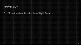 IMPRESSION
▪ Closed fracture bimalleolar of Right Ankle
13
 