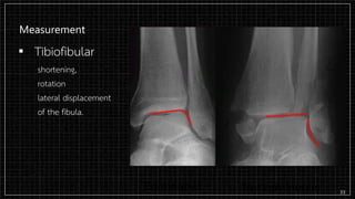 Measurement
▪ Tibiofibular
shortening,
rotation
lateral displacement
of the fibula.
33
 