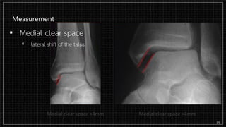 Measurement
▪ Medial clear space
▫ lateral shift of the talus
35
 