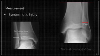 Measurement
▪ Syndesmotic injury
36
 