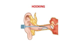 Docking Ear Process Diseases of External Ear | PPTX
