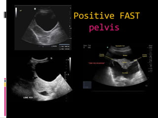 Fast Views Extended focused abdominal assesment in trauma patients | PPTX