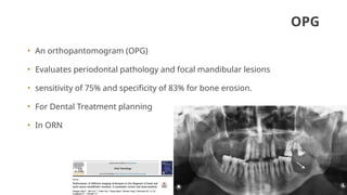 Opg Infection IMAGING IN ORAL CANCER | PPTX