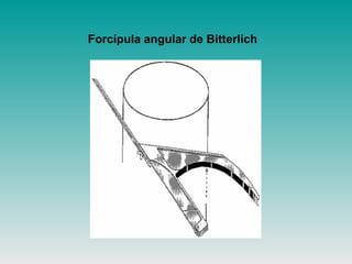 Forcípula angular de Bitterlich
 