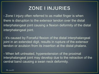 - Zone I injury often referred to as mallet finger is when
there is disruption to the extensor tendon over the distal
interphalangeal joint causing a flexion deformity of the distal
interphalangeal joint.
- It’s caused by Forceful flexion of the distal interphalangeal
joint in an extended digit, results in rupture of the extensor
tendon or avulsion from its insertion at the distal phalanx.
- When left untreated, hyperextension of the proximal
interphalangeal joint may develop due to the retraction of the
central band causing a swan neck deformity.
01،‫نيسان‬16
 