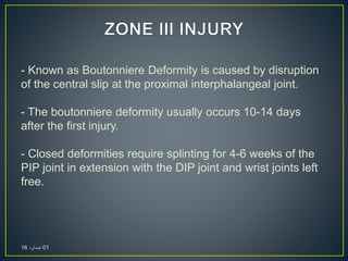 - Known as Boutonniere Deformity is caused by disruption
of the central slip at the proximal interphalangeal joint.
- The boutonniere deformity usually occurs 10-14 days
after the first injury.
- Closed deformities require splinting for 4-6 weeks of the
PIP joint in extension with the DIP joint and wrist joints left
free.
01،‫نيسان‬16
 