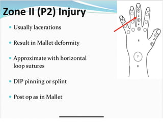 Extensor tendon injuries | PPTX