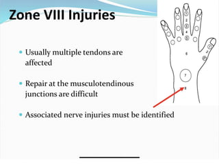 Extensor Tenon Injury Extensor tendon injuries | PPTX