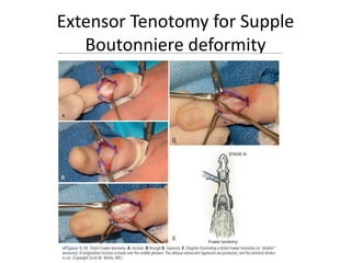 Extensor Tenotomy for Supple
Boutonniere deformity
 