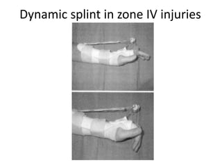 Dynamic splint in zone IV injuries
 