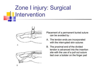 Extensor tendon injury | PPTX