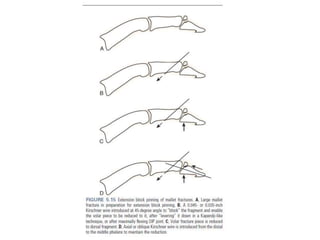 Extensor tendon injury | PPTX