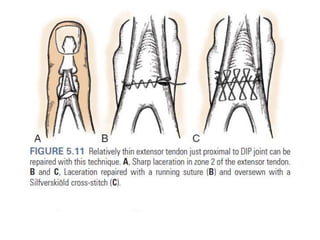 Extensor tendon injury | PPTX