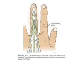 Extensor Tenon Injury Extensor tendon injury | PPTX