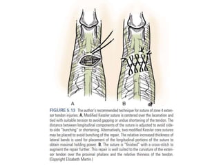 Extensor tendon injury | PPTX