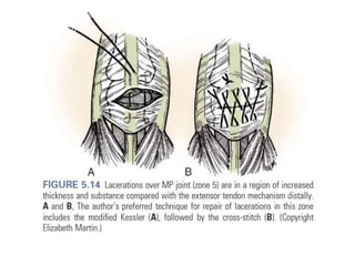 Extensor tendon injury | PPTX
