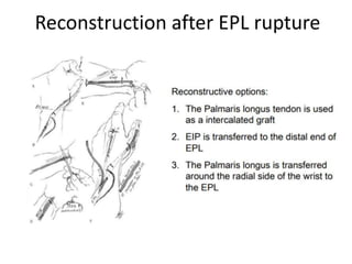 Reconstruction after EPL rupture
 