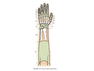 Extensor tendon injury | PPTX