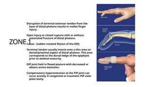 Comprehensive Principles and Techniques of Extensor Tendon Repair in ...