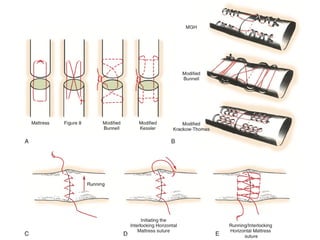 Extensor tendon anatomy, injury and its mangement pptx | PPTX