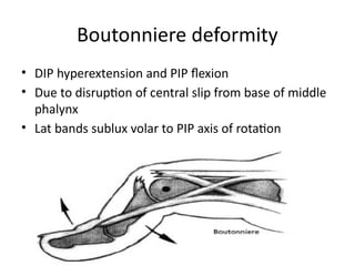 Sublux Ex management of extensor tendon injury.pptx