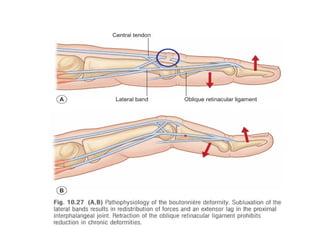 management of extensor tendon injury.pptx