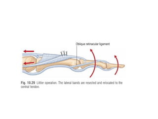 management of extensor tendon injury.pptx