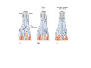 management of extensor tendon injury.pptx