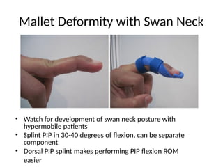 Pip Rom Comprehensive Management of Extensor Tendon Injuries: Repair ...