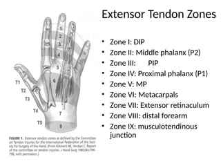 Comprehensive Management of Extensor Tendon Injuries: Repair ...
