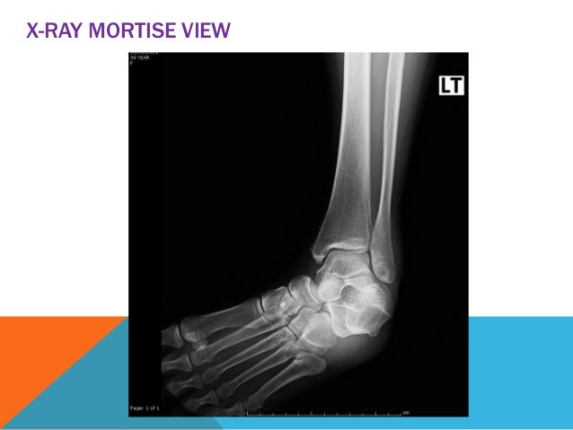 Extern Conference Ankle