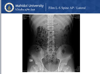Film L-S Spine AP / Lateral
 