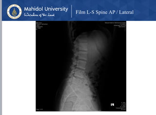Film L-S Spine AP / Lateral
 