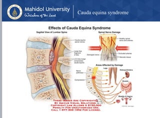 Cauda equina syndrome
 
