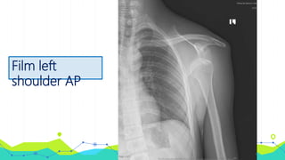 Film left
shoulder AP
 