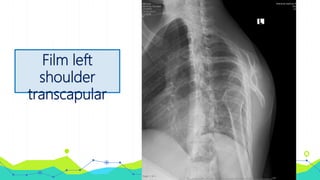 Film left
shoulder
transcapular
 