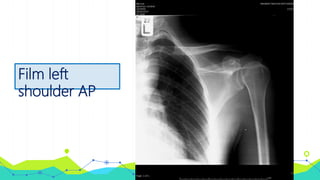 Film left
shoulder AP
 