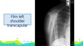 Film left
shoulder
transcapular
 