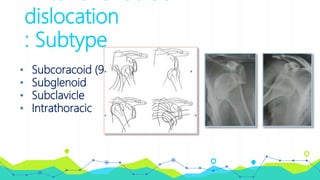 dislocation
: Subtype
• Subcoracoid (90%)
• Subglenoid
• Subclavicle
• Intrathoracic
 