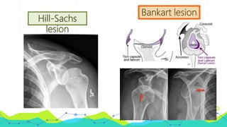 Hill-Sachs
lesion
Bankart lesion
 